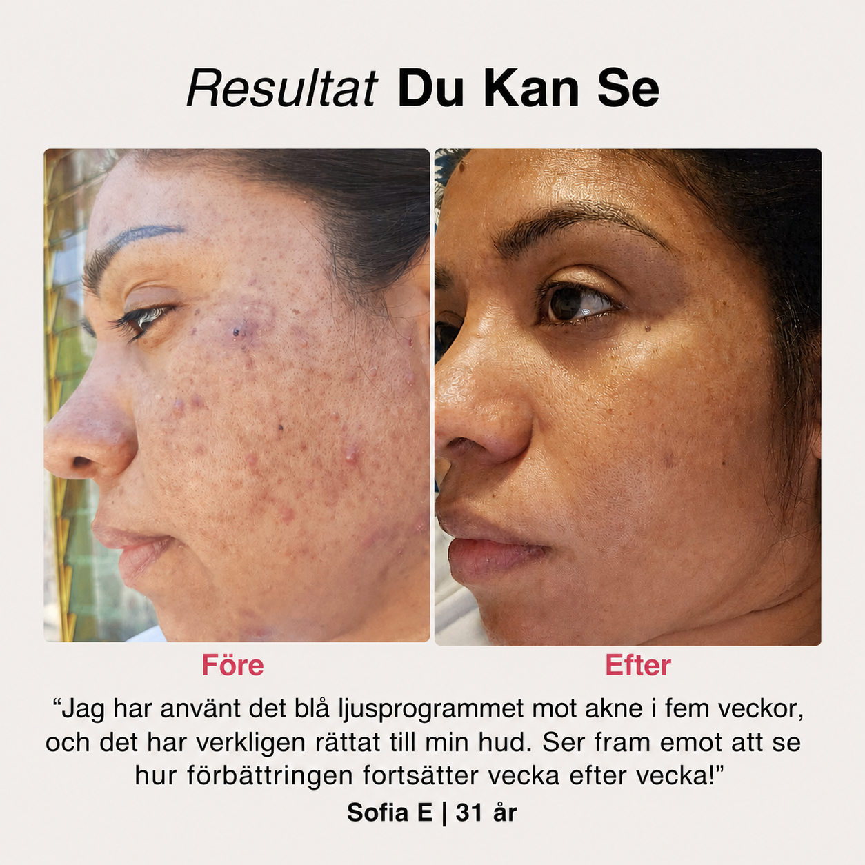 SoftSkin InfraLight® LED-mask