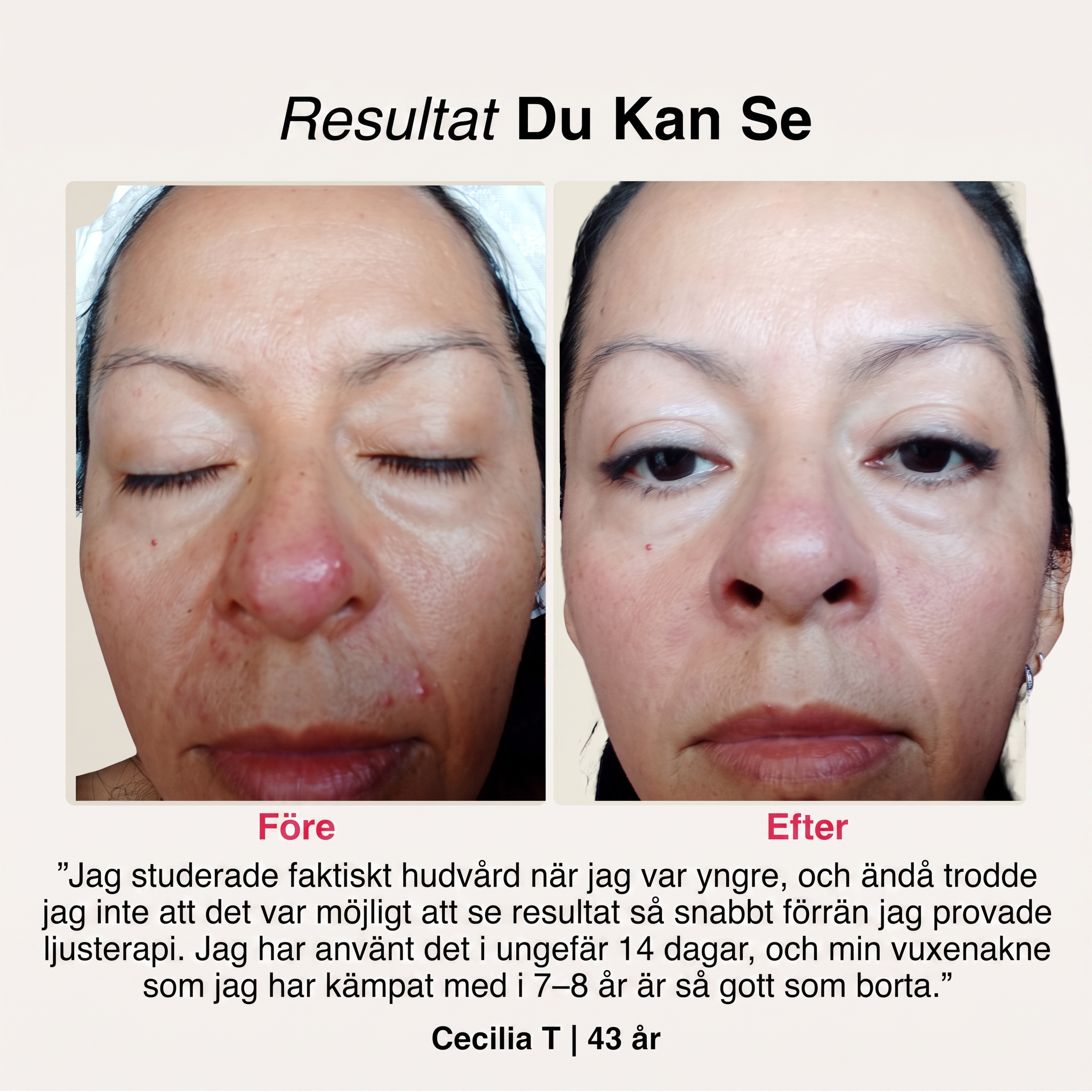 SoftSkin InfraLight® | Ansikte, Hals & Bröst