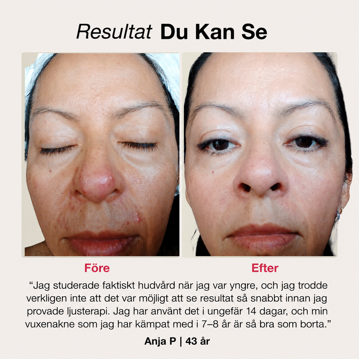 SoftSkin InfraLight® LED-mask